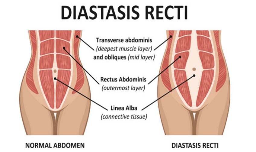 Understanding Diastasis Recti: AKA "Mummy Tummy" - Liberty Physio