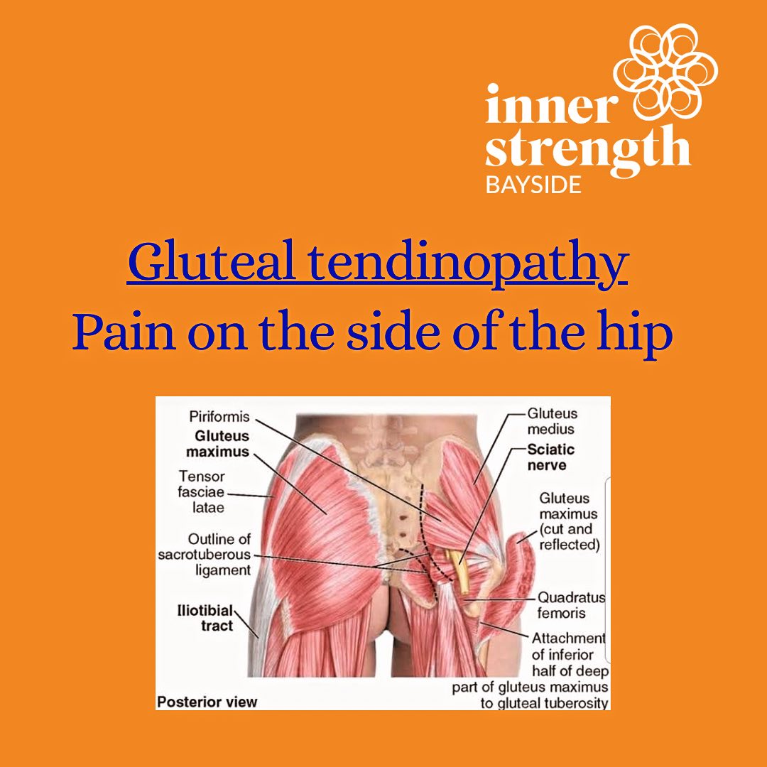 Pain on the outside of the hip can make walking, stair climbing, getting up from chairs very difficult. Come see one of our physiotherapists for a tailored assessment of your hip and exercise program if you are experiencing hip pain.
